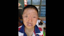 全球罕见！12岁男孩患上“吸血鬼症”，晒太阳皮肤溃烂脱皮